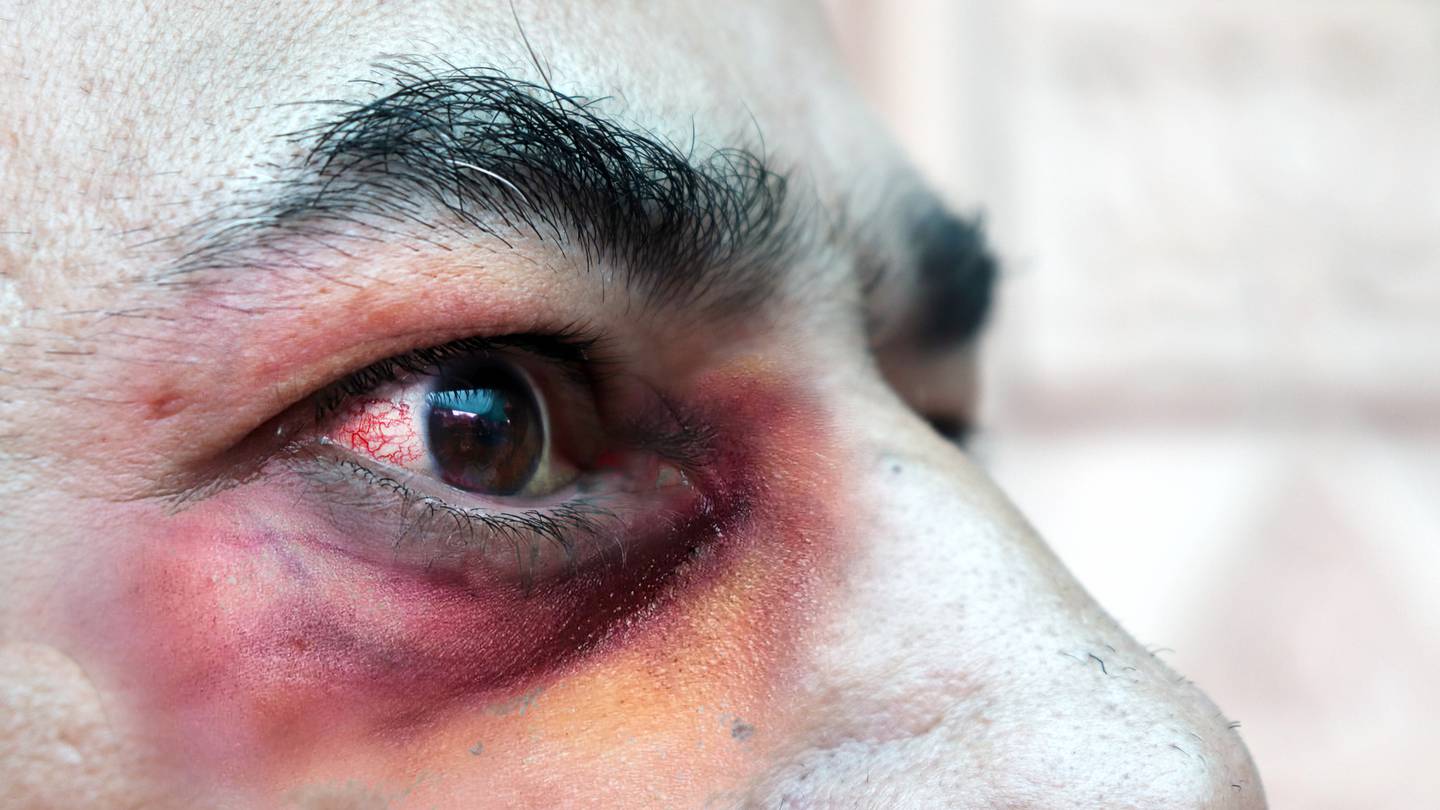 Se detectan dos casos de hongo negro en Guerrero