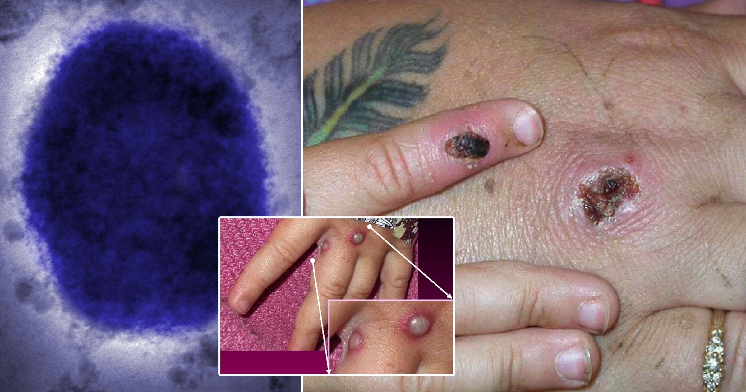 Nueva pandemia mundial se avecina: la viruela del mono ya llegó a América