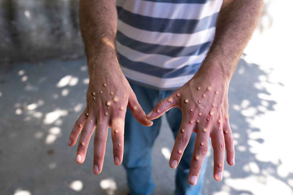 Refuerza vigilancia epidemiológica la SS Guerrero,  ante el anuncio de la OMS sobre Viruela del Mono