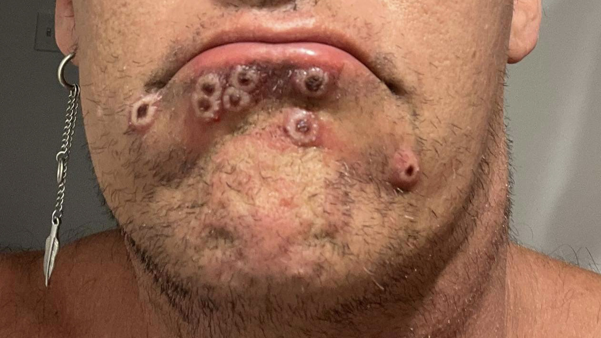 Aumenta a 252 casos confirmados de viruela del mono en México